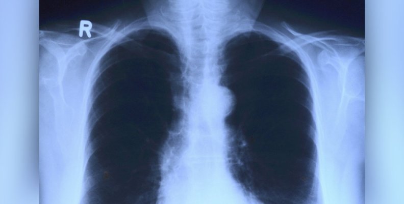 Pulmones