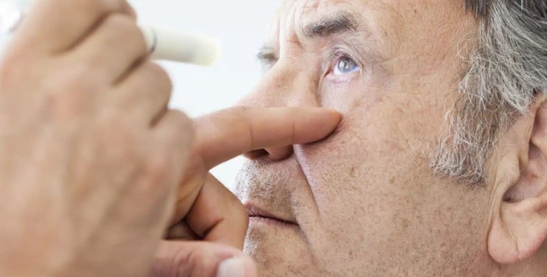 Hombre con el ojo abierto. Van a aplicarle gotas 